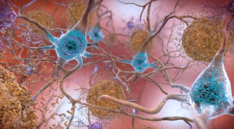 Alzheimer, proteina chiave svelata in alta definizione